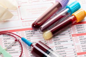 آنچه باید درباره آزمایش قند خون ناشتا بدانید